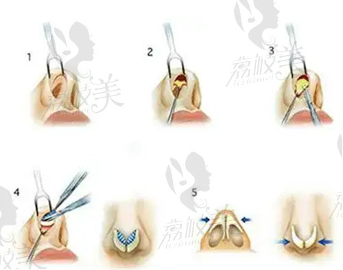 中山愛思特的隆鼻技術(shù)高超