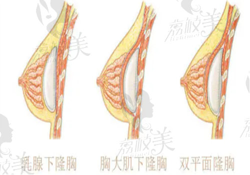 深圳貝加美醫(yī)療美容整形萬蕓假體隆胸技術(shù)