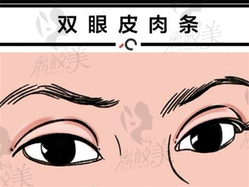 大連劉志剛整形醫(yī)院修復(fù)雙眼皮實(shí)例