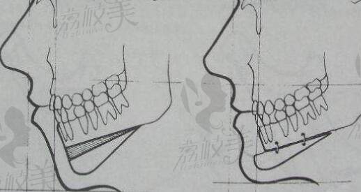 周會喜正頜手術(shù)做的怎么樣