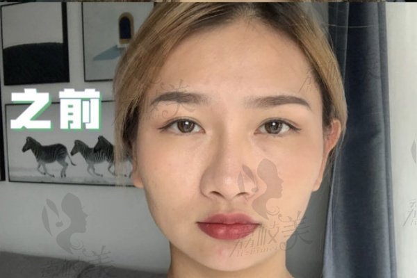沈敞原打玻尿酸怎么样