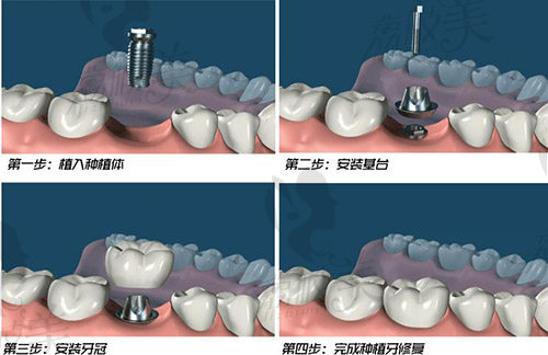 种植牙过程