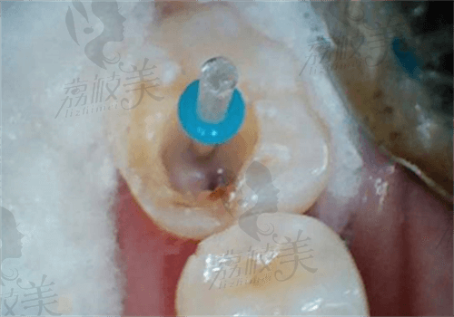 厦门根管治疗可以用医 保吗？