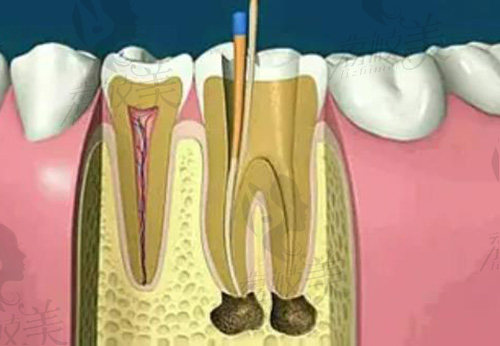深圳根管治疗加补牙多少钱一颗