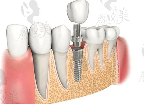 种植牙图片