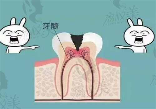 牙根吸收牙齿松动的解决办法之根管治疗