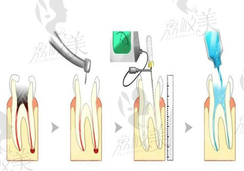 牙根吸收牙齿松动的解决办法之使用牙周夹板进行固定