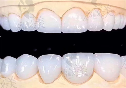 牙根吸收牙齿松动的解决办法之拔掉再种