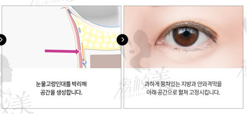 韩国大眼睛整形医院修复眼袋退缩怎么样