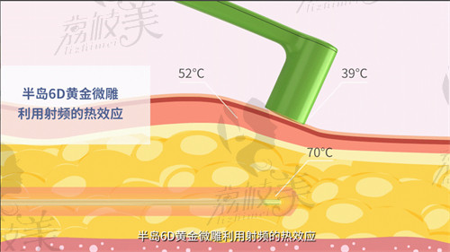 厦门欧菲黄金微雕吸脂技术口碑良好