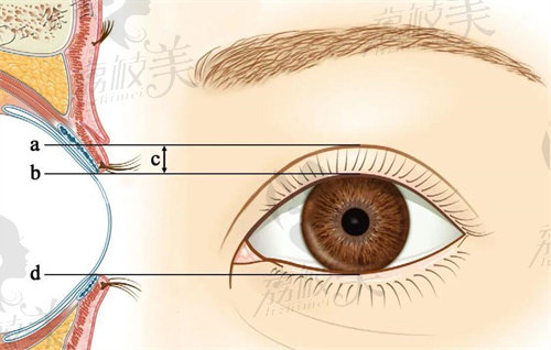 沈陽美萊整形做雙眼皮怎么樣？