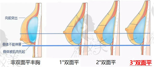 徐宇红医生隆胸怎么样