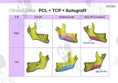 韩国欧佩拉整形PCL补骨