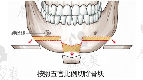 韓國磨骨醫(yī)院排行榜前十