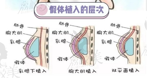 蘇州美貝爾童列健內(nèi)窺鏡假體豐胸優(yōu)勢(shì)匯總