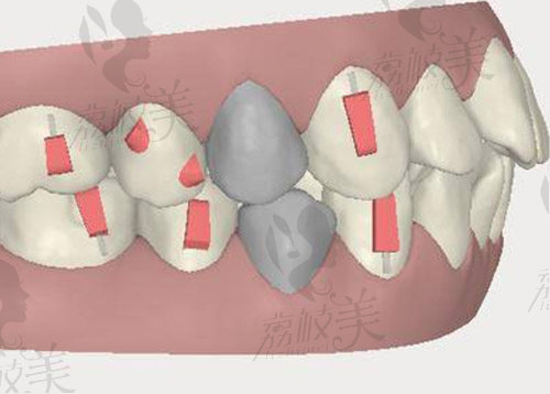 牙齿矫正图片