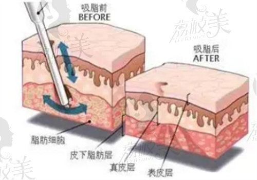 重慶腰腹吸脂哪家醫(yī)院好？