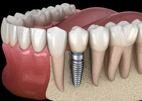 种植牙图片