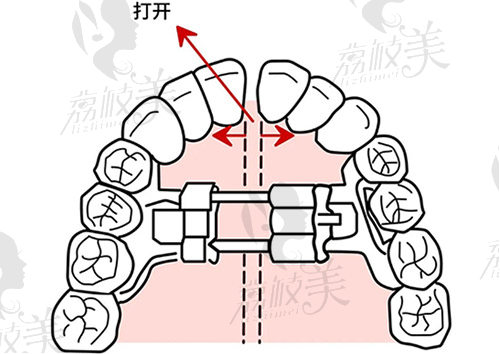 儿童牙齿早期扩弓图片