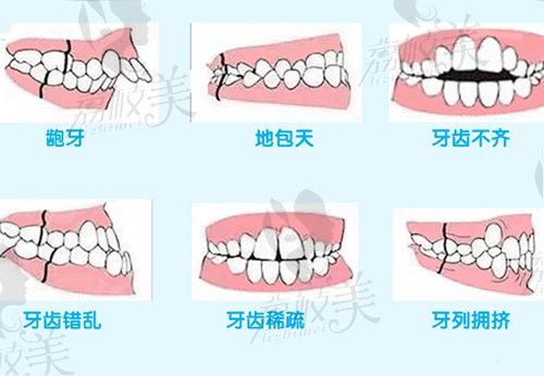 牙齿畸形类型