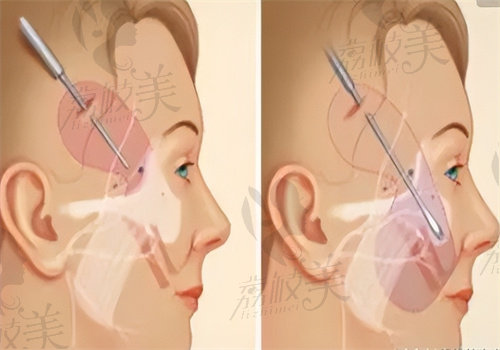 广州医美俪整形埋线提升怎么样