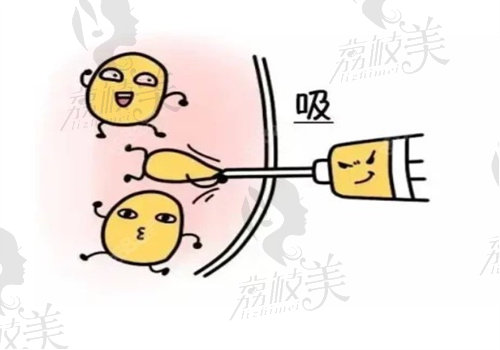1717575834808808.jpg 吸脂动漫图.jpg