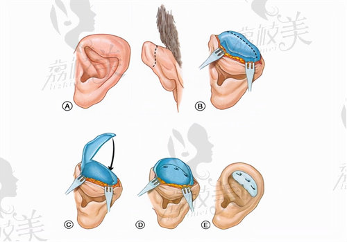 北京丽都郭志华耳再造手术成效怎么样
