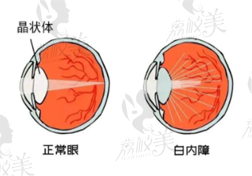 重庆做白内障手术哪家医院好？