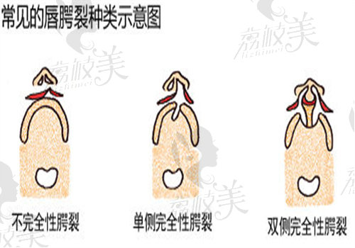 南京施爾美李彤彤醫(yī)生唇裂手術(shù)特點(diǎn)