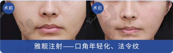 口角年轻化.jpg