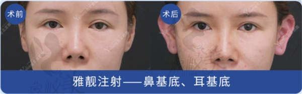 鼻基底.jpg
