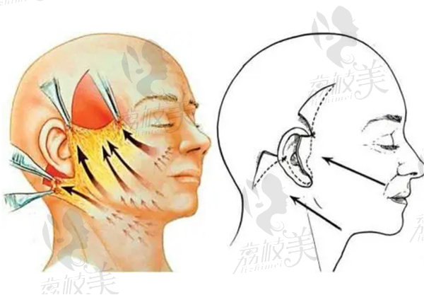 無痕水波拉皮和大拉皮有什么區(qū)別