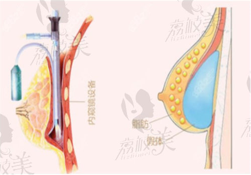 蒙喜永隆胸怎样？