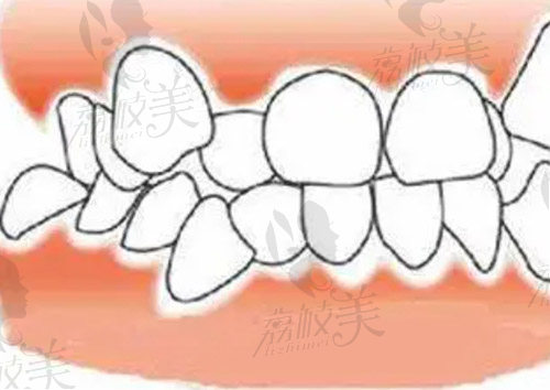 牙齿不齐图片