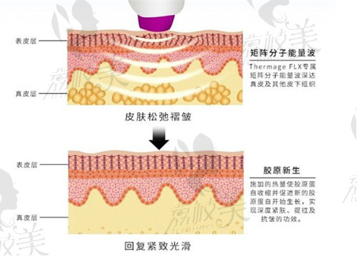 电波拉皮的功效有哪些
