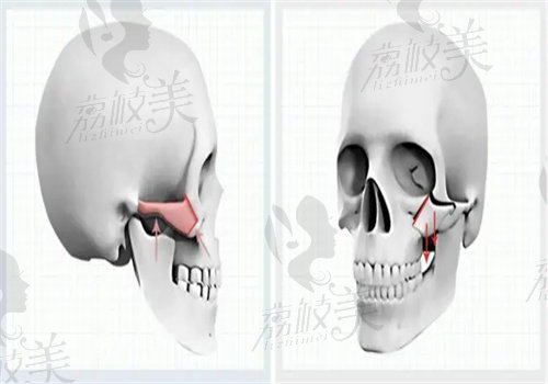 朴相薰亲自手术费用：2W-15W元起