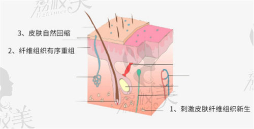 土麥森吸脂是什么