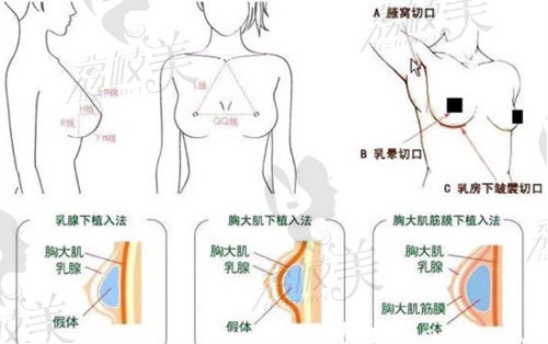 深圳艺星孙湄杨隆胸口碑怎么样