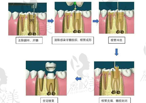 根管治疗全过程