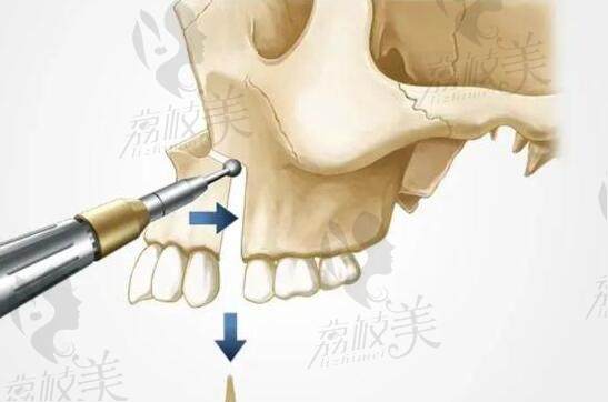 重庆王涛正颌手术费用是多少