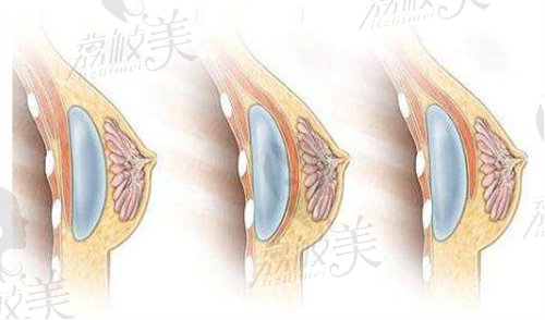 林彪斌医生隆胸技术怎么样？