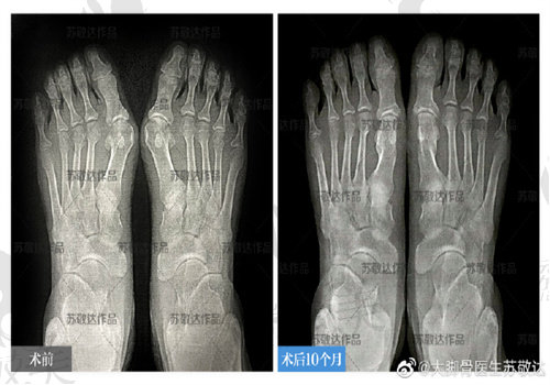 蘇敬達大腳骨手術怎么樣