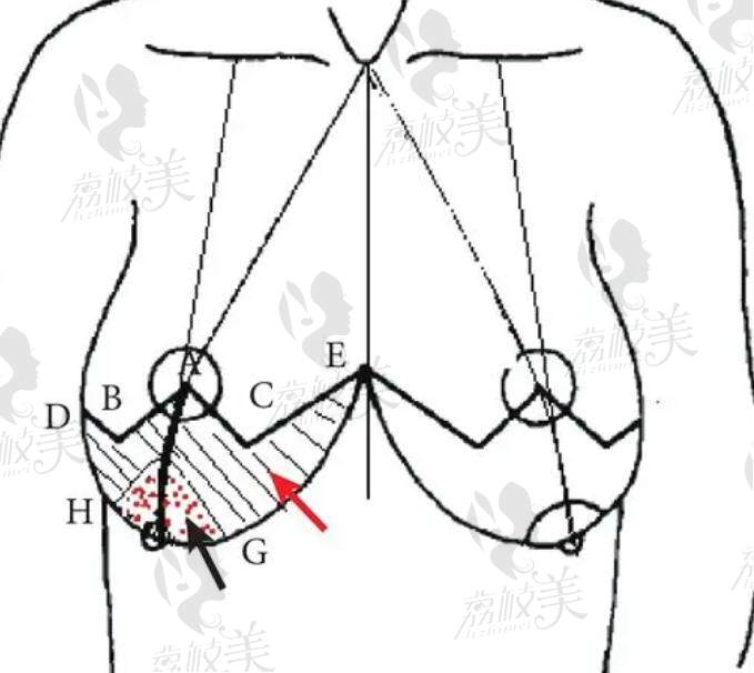 鄭州趙絳波做縮胸手術(shù)多少錢