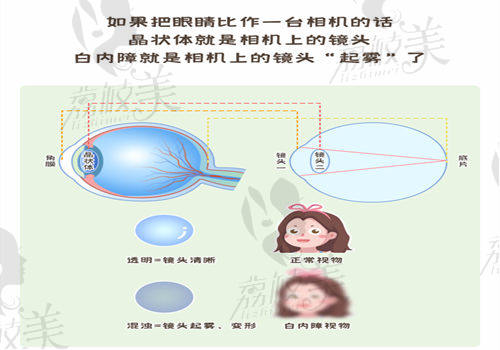 上饶启明眼科医院白内障手术费用：4000元起