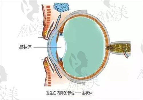 上饶启明眼科医院白内障手术示例分享