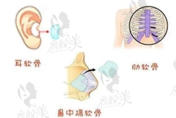 李冰肋软骨隆鼻适合哪些人