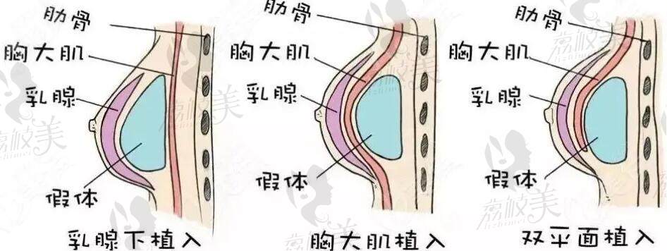 徐国建隆胸价格