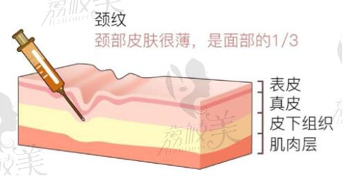 嗨體去頸紋1.5和2.5的區(qū)別是什么？