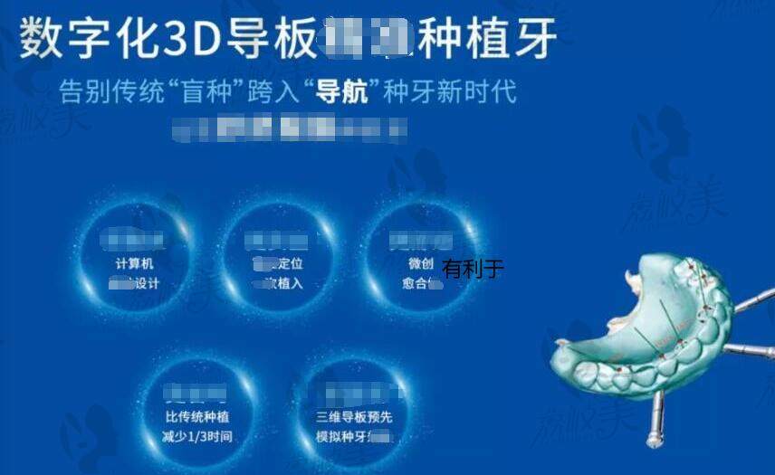 北京协和医院口腔科种植牙价格多少钱