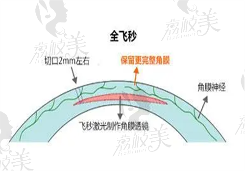 深圳做全飞秒手术多少钱？